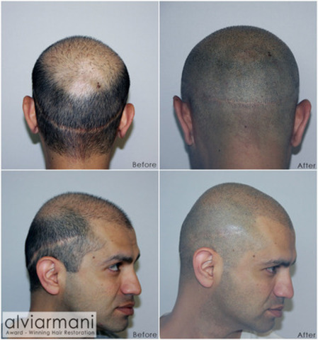 New hair loss treatment option; Alvi Armani Brings Scalp Micropigmentation  to the Table